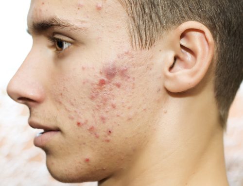 10 Ten Skincare Tips for Acne