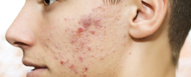 teenager with bad acne - skincare tips for acne concept