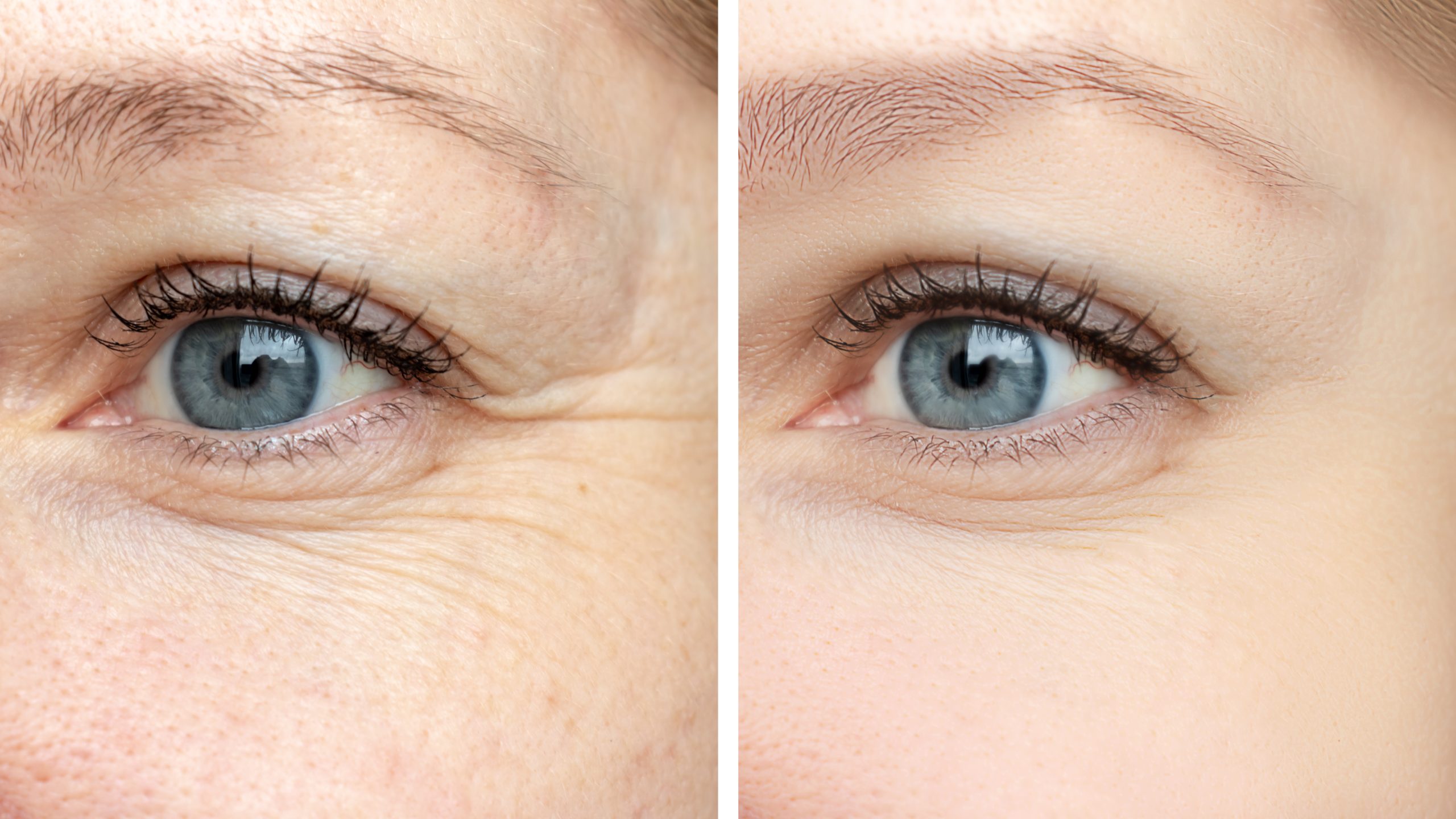 woman's eyes - before and after eye wrinkle treatments