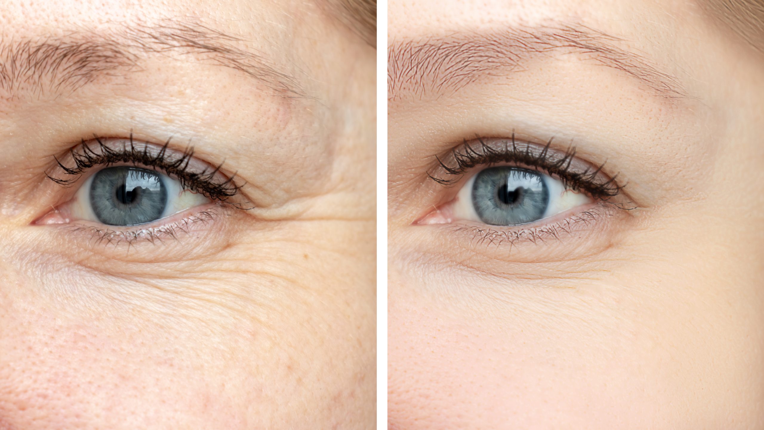 Eye Wrinkle Treatments Here are the Most Effective Options