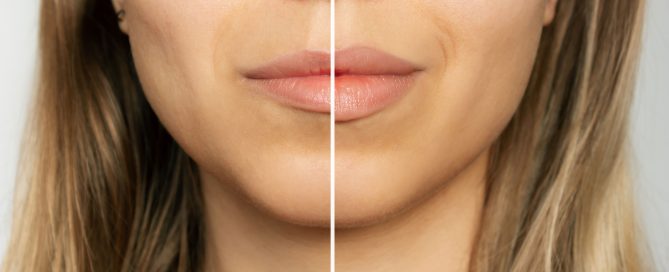 Lip enhancement procedure - before and after - Aesthetic Rejuvenation Center