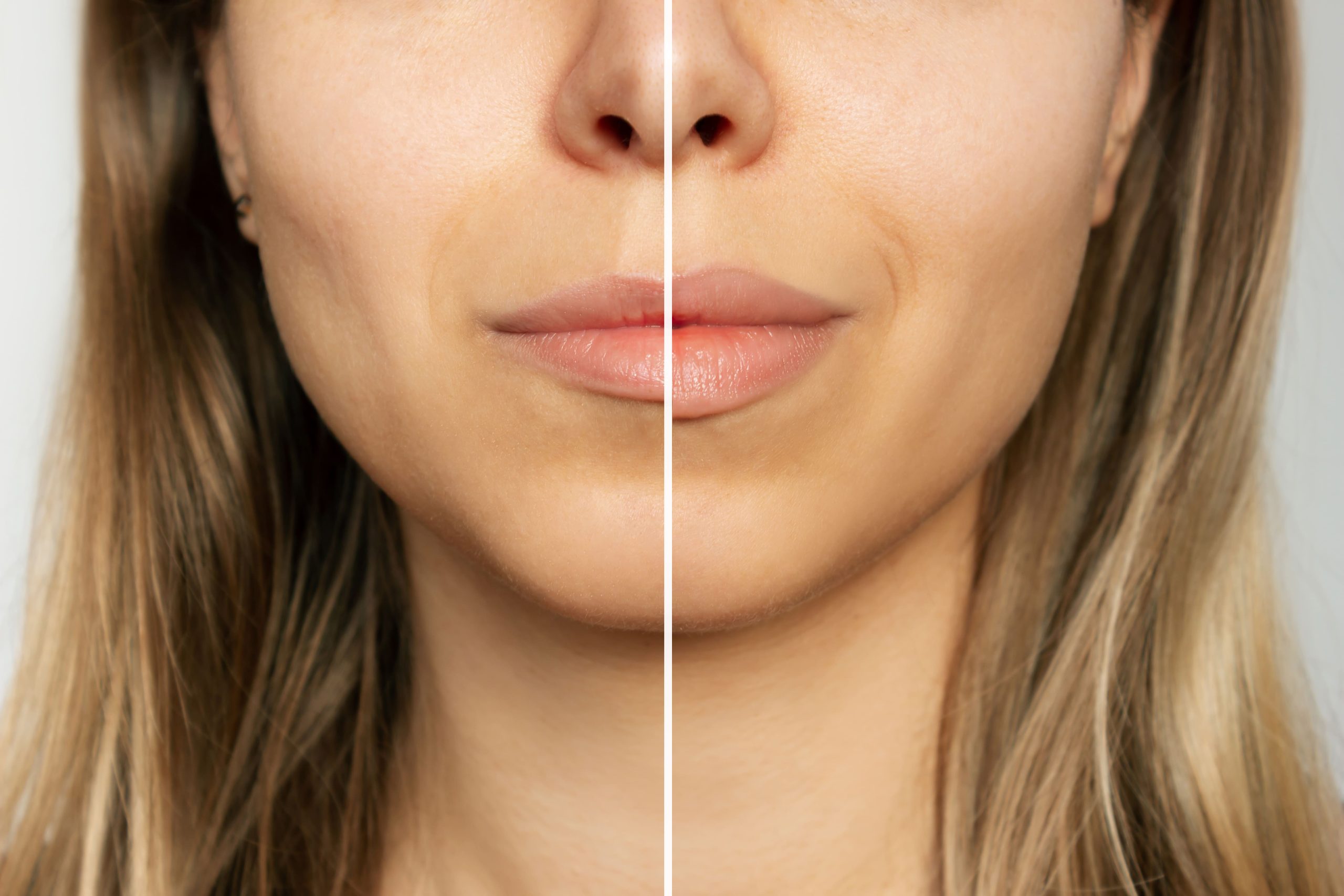Lip enhancement procedure - before and after - Aesthetic Rejuvenation Center